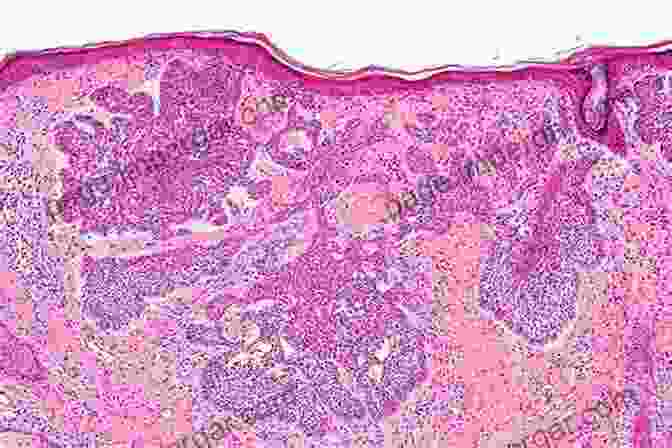 Microscopic Image Of A Skin Lesion, Showing Characteristic Features Practical Dermatopathology Ronald P Rapini